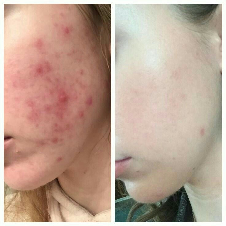 KORMESIC 10% Benzoyl Peroxide Intensive Acne Gel 30ml